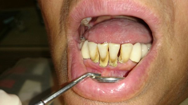 “AQS dental center” tövsiyə edir: diş ərplərindən necə xilas olmalı?