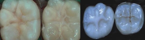 Çeynəmə dişləri necə qoruyaq? - "AQS dental center" tövsiyə edir