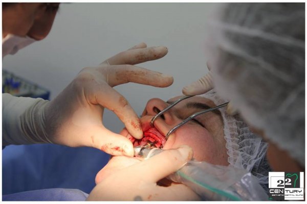 İyirmi İkinci Əsr Klinikasında dişlərin implantasiyası necə edilir?