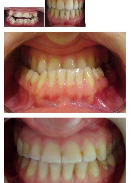 Valideynlərin nəzərinə: uşaq yaşlarında dişlərdə... - “AQS dental center” tövsiyə edir Valideynlərin nəzərinə: uşaq yaşlarında dişlərdə... - “AQS dental center” tövsiyə edir