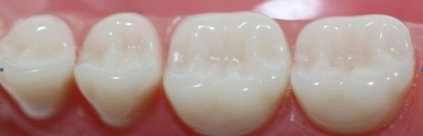 Hansı plomb daha yaxşıdır? - "AQS dental center”dən TÖVSİYƏ