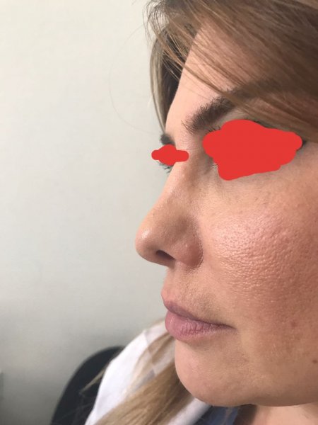 Türkiyədə burnu yalnış əməliyyat olunan azərbaycanlı qadın səfirə müraciət etdi -FOTO