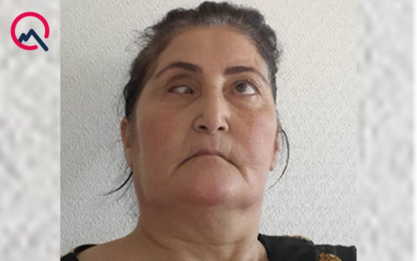 Sumqayıtda burun əməliyyatına girən qadının gözündə çəplik yarandı - FOTO Sumqayıtda burun əməliyyatına girən qadının gözündə çəplik yarandı - FOTO